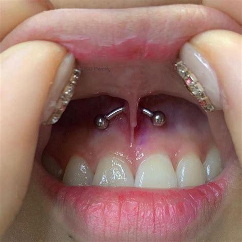 The jewelry is inserted into the skin, connecting the upper lip with a gum (frenulum). . Frenulum piercing